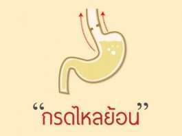 ภาวะกรดไหลย้อน