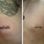 Nipple Removal
