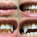 Vampire Teeth Implants