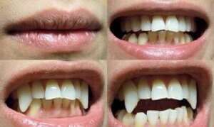 Vampire Teeth Implants