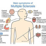 multiple sclerosis