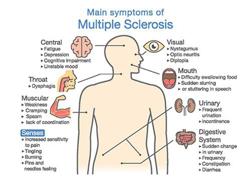 Multiple Sclerosis