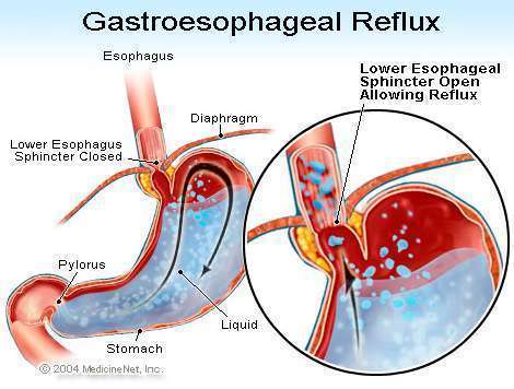 gastroesophageal reflux